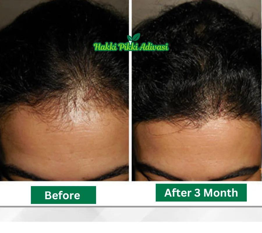 hakki-pikki-adivasi-hair-oil-before-after.-original-website
