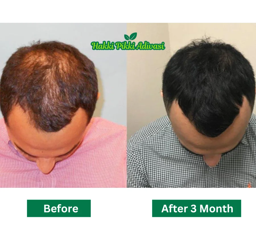 hakki-pikki-adivasi-hair-oil-before-after.-real